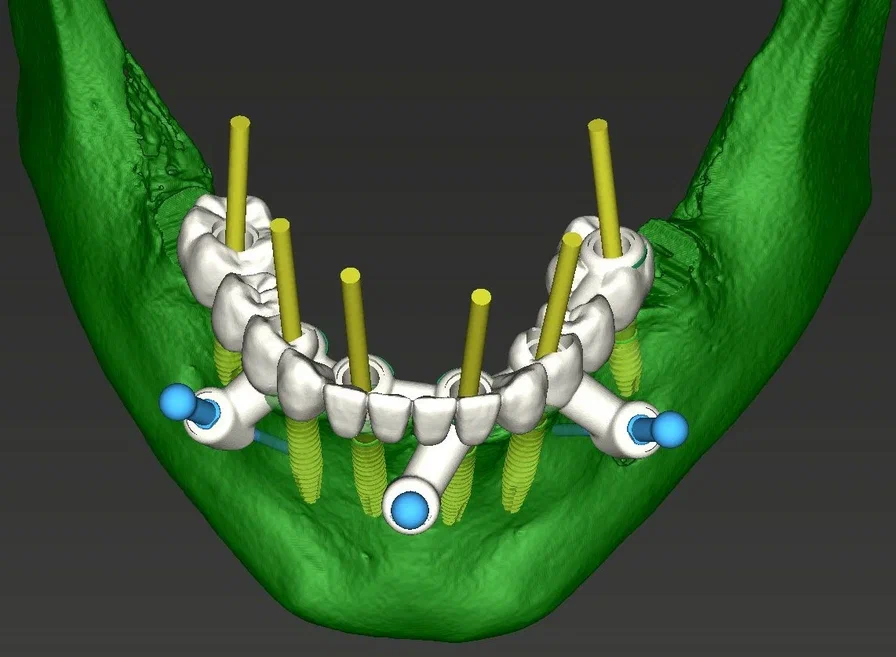 Как врачи-стоматологи «Дантистофф» помогли онкопациенту вернуть все зубы