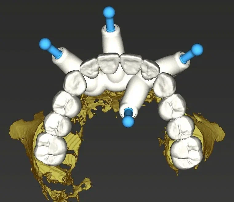 Как врачи-стоматологи «Дантистофф» помогли онкопациенту вернуть все зубы